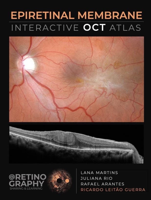 Capa do livro EPIRETINAL MEMBRANE - INTERACTIVE OCT ATLAS