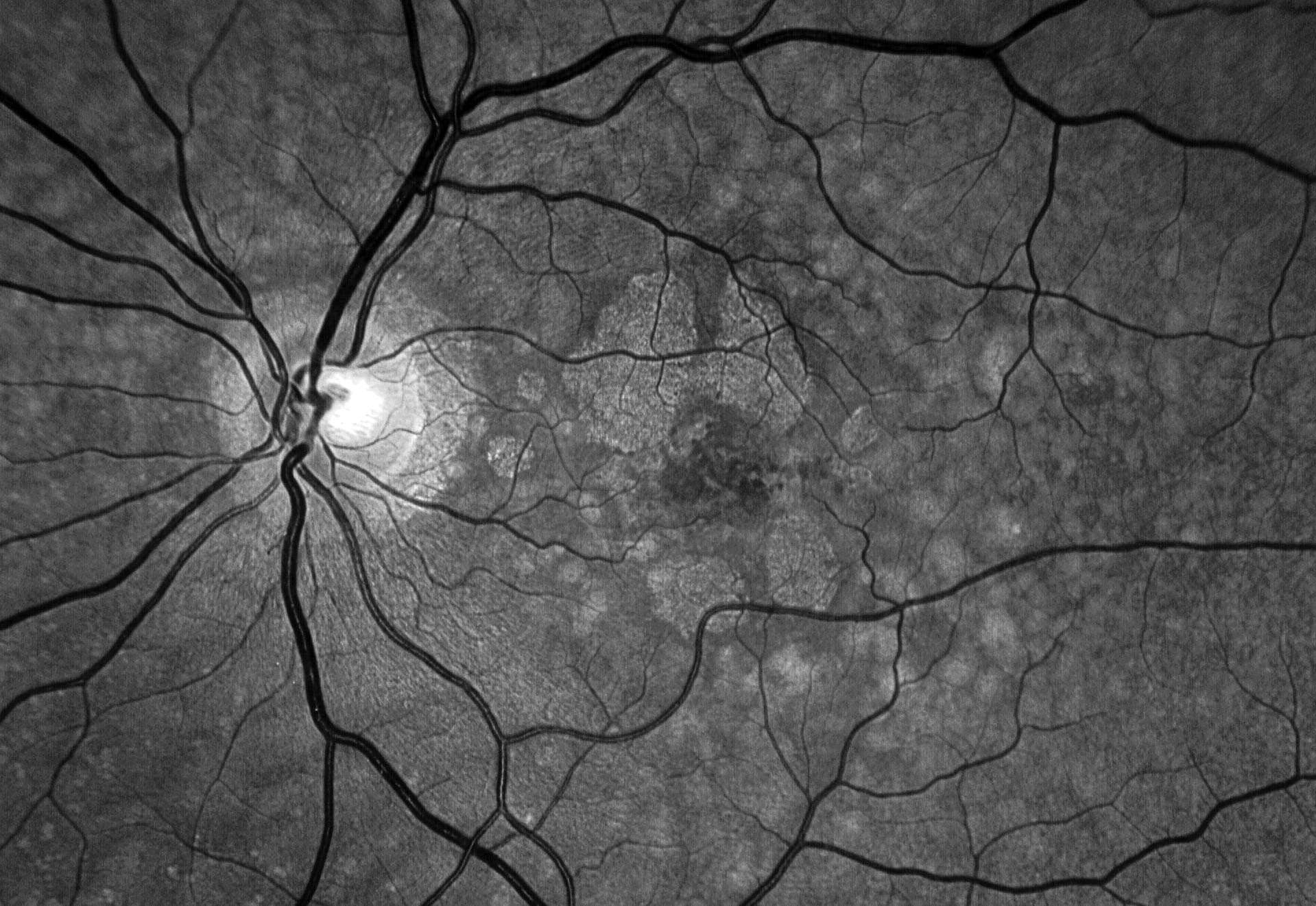 Retinography Hero Retina