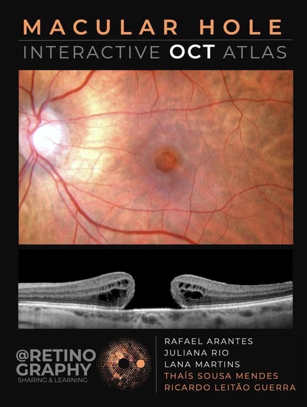 Capa do livro MACULAR HOLE - INTERACTIVE OCT ATLAS