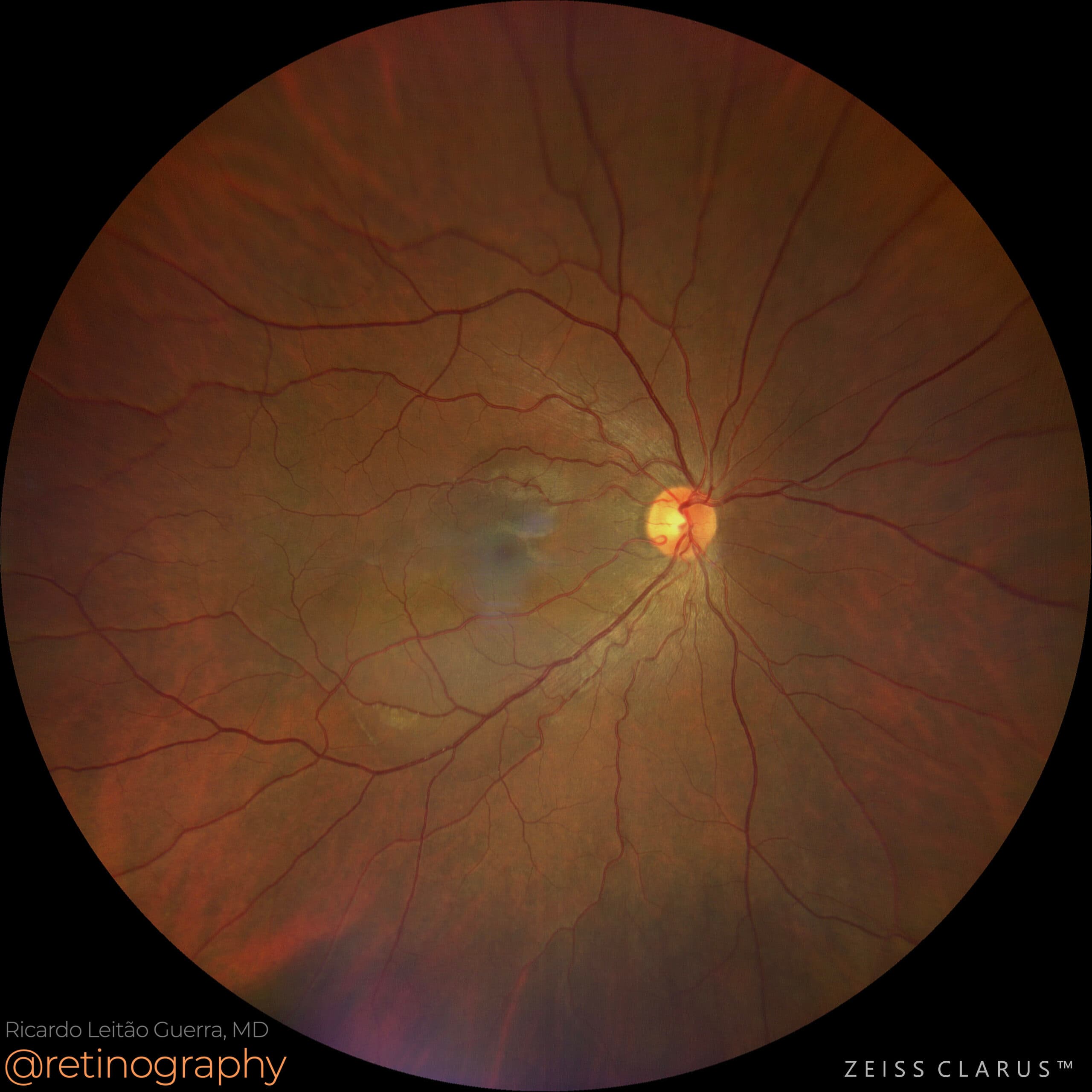 Central Serous Chorioretinopathy