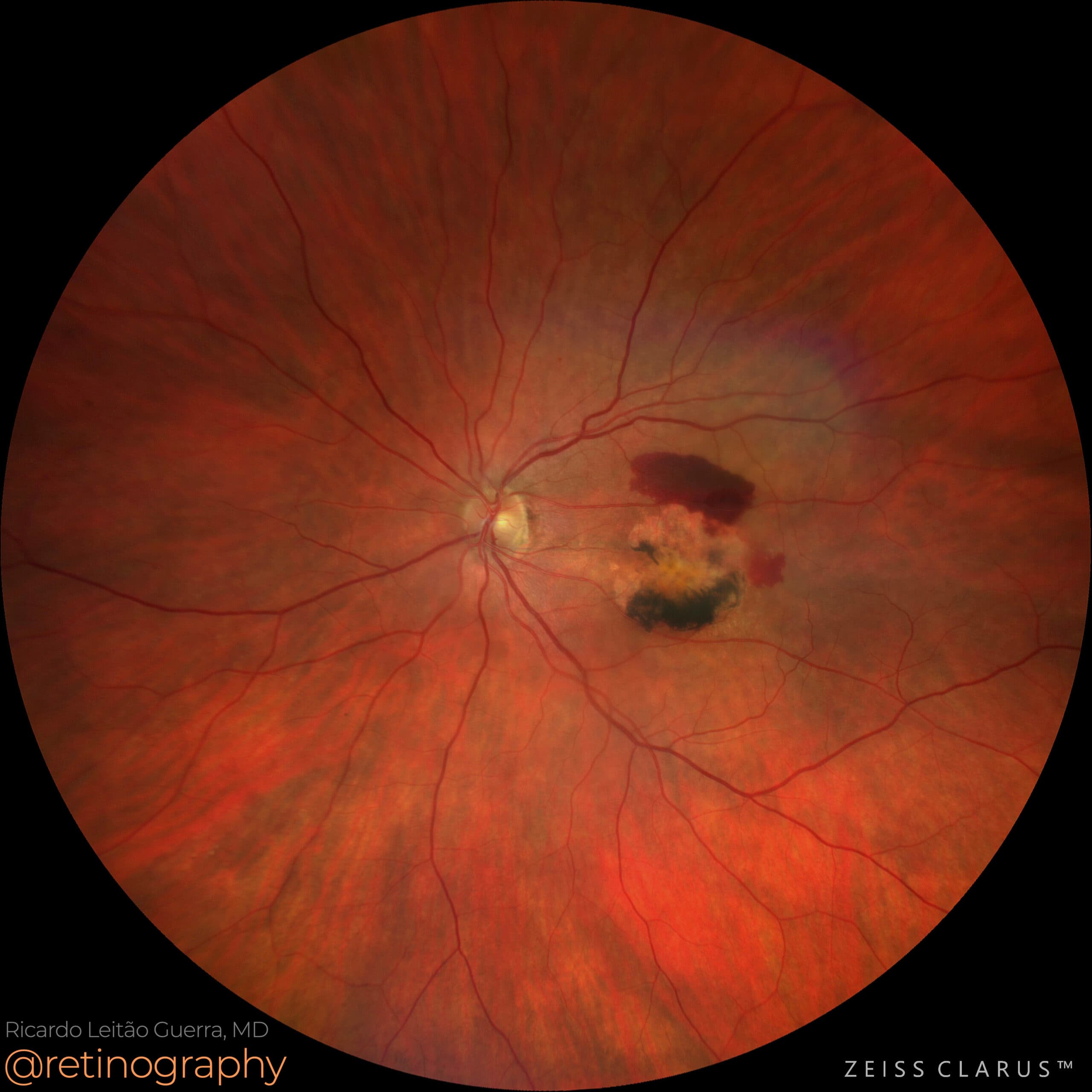 AMD: Outer retinal tubulations