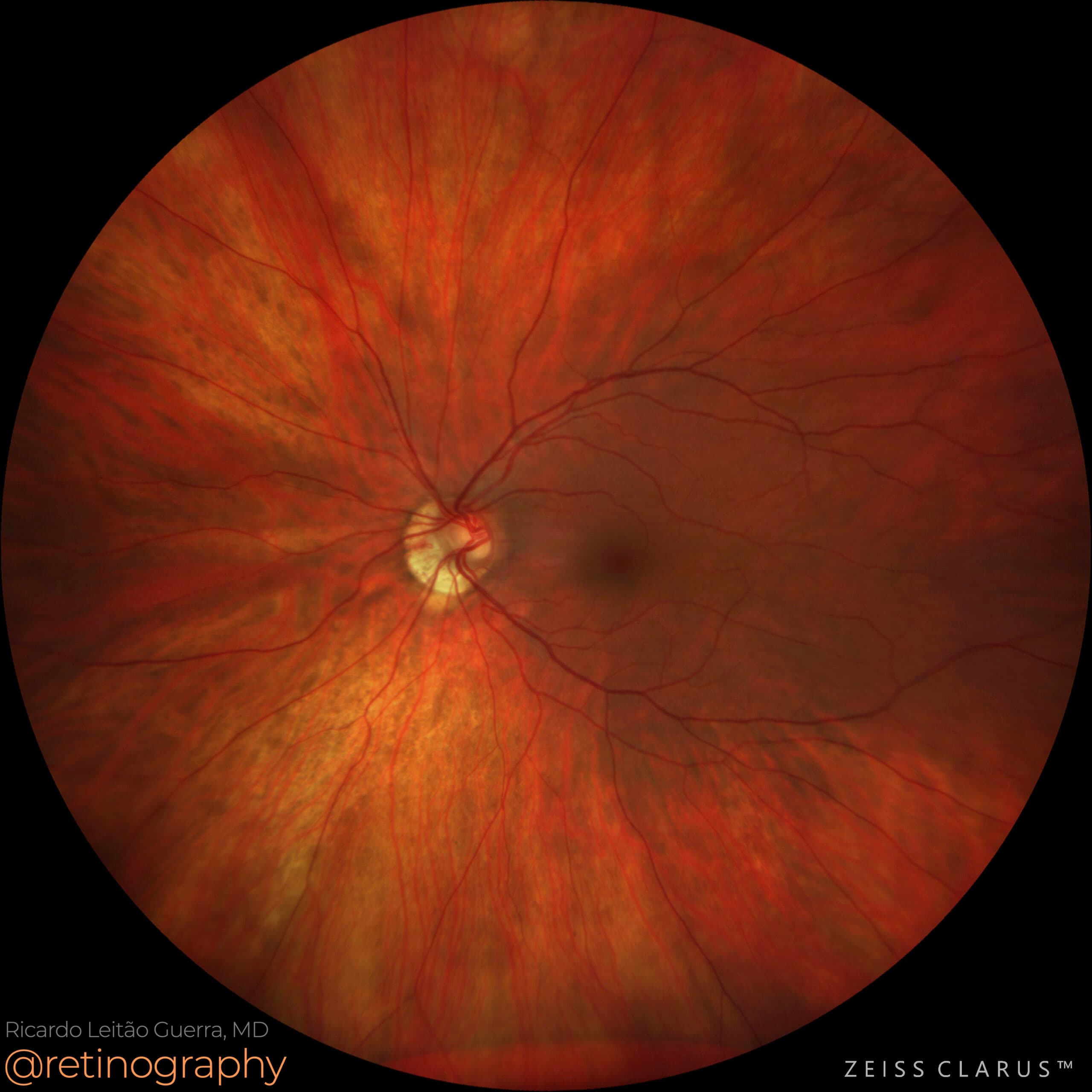 Situs inversus: Degenerative myopia