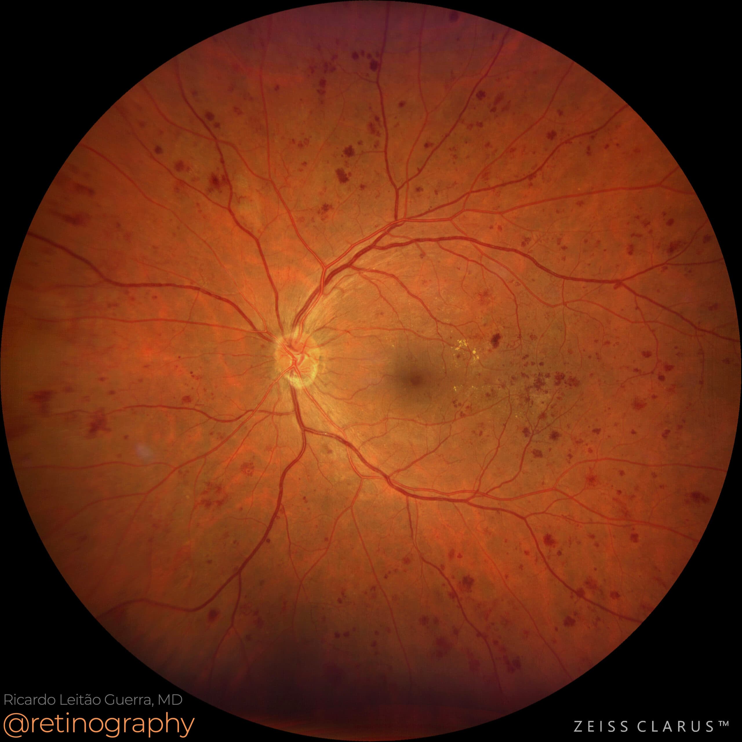 Proliferative diabetic retinopathy