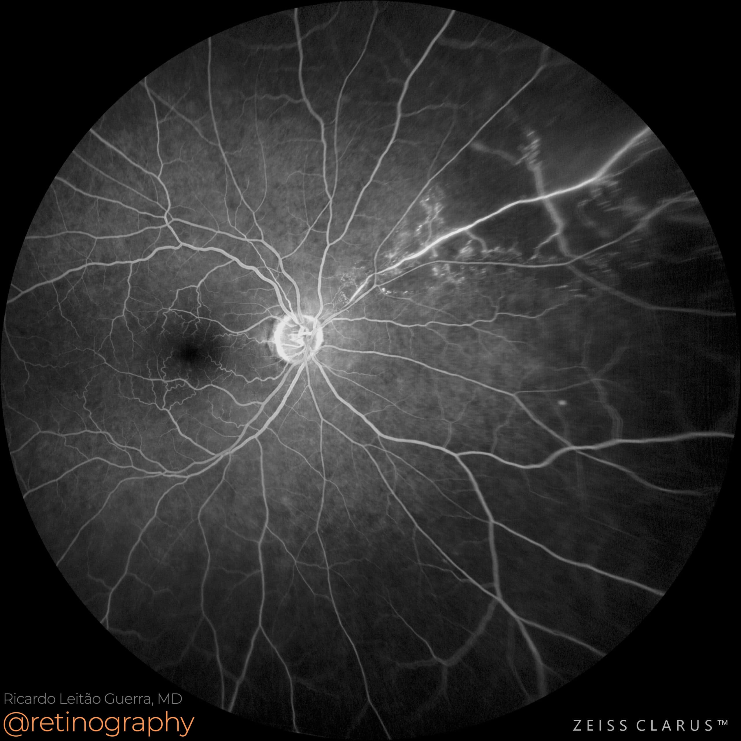 Asymptomatic BRVO